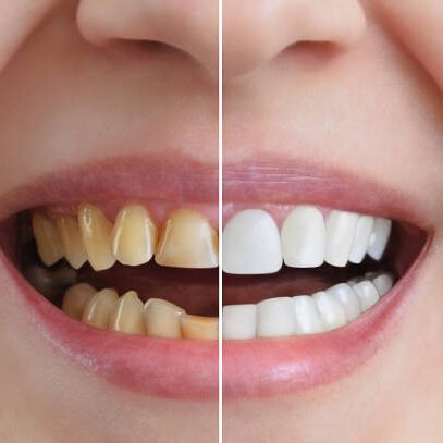 service-1-1 cosmetic dentistry img